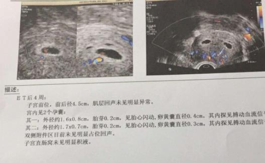 b超显示后壁什么意思