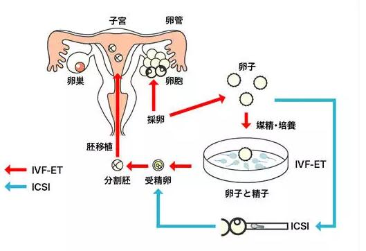 宫腔内配子移植