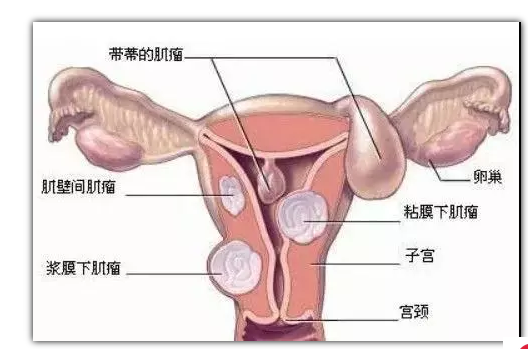 子宫切除的原因有哪些？子宫切除对身体有哪些影响？.png