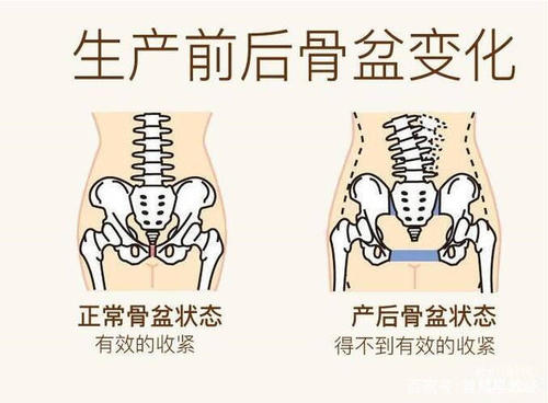 骨盆修复有必要吗.jpg