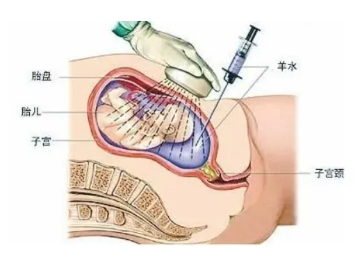 羊膜穿刺多少钱.png