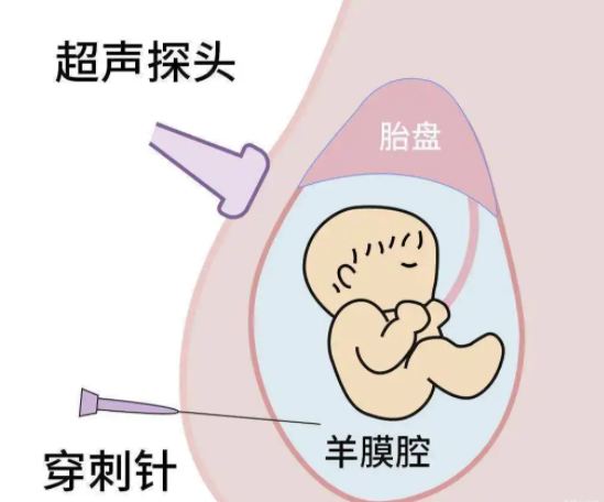 羊水穿刺到底是一种什么样的体验呢 羊水穿刺多长时间出结果报告呢.png