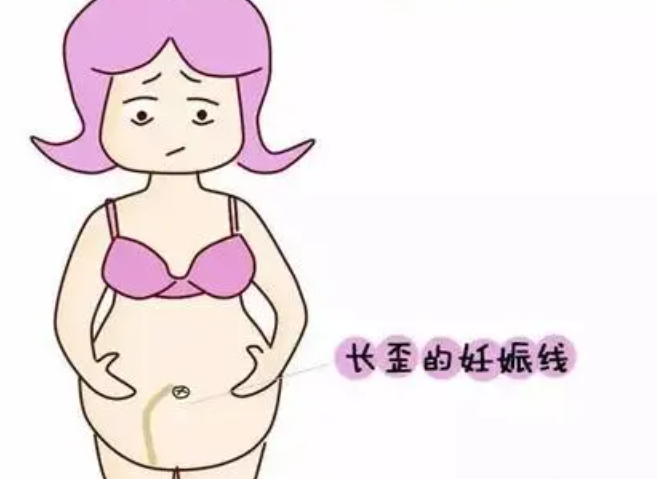 妊娠线浅细是男孩女孩.png